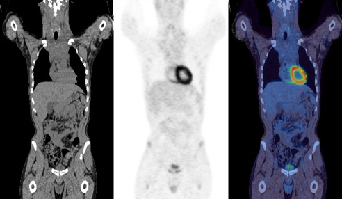 pre-treatment PET/CT