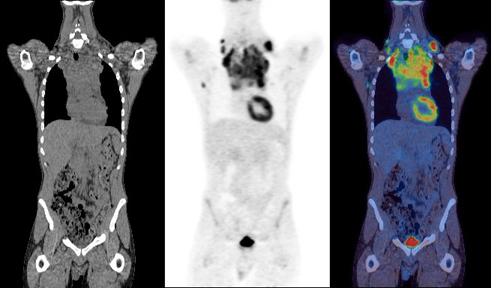 pre-treatment PET/CT